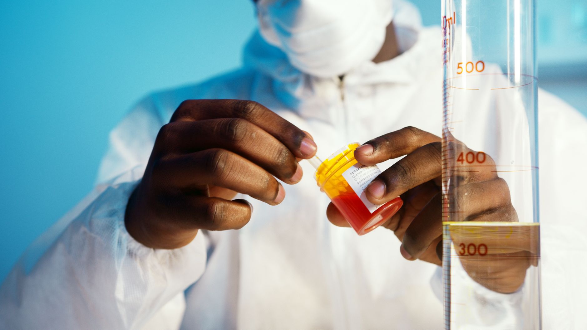 person holding a plastic bottle with orange liquid Methadone rots teeth and bones